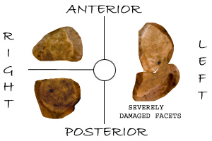 Articular facets of the occipital condyles